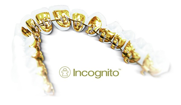 Incognito™ Lingual Braces