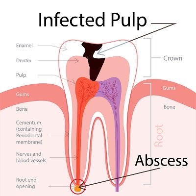 root canal treatment