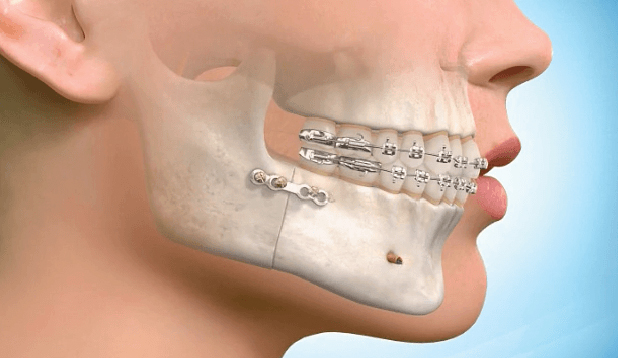 Surgical Orthodontics | Power Smile Dental Centre South ...