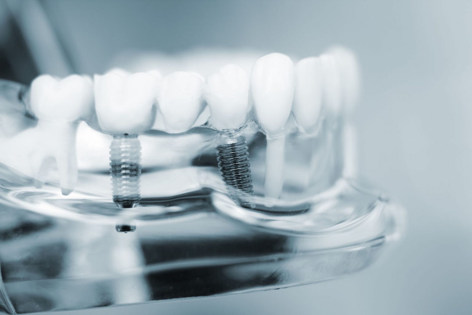 Global Dental Implant and Prosthetic Market Is expected to Witness a